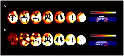 Differences in the amplitude of low-frequency fluctuations of spontaneous brain activity between preterm and term infants